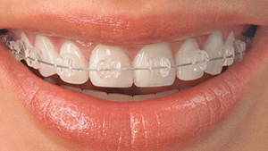 Ceramic Braces in Lees Summit and Pleasant Hill MO