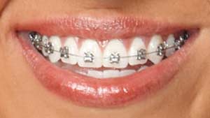 Metal braces in Lees Summit and Pleasant Hill MO