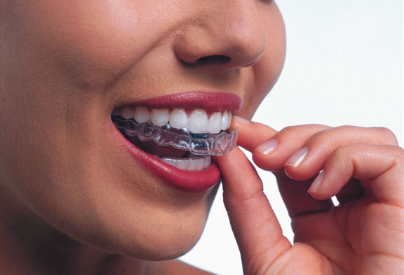 Invisalign Orthodontist in Greenwood