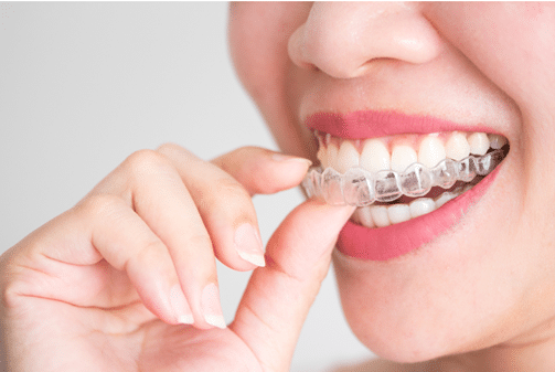 Invisalign in Independence