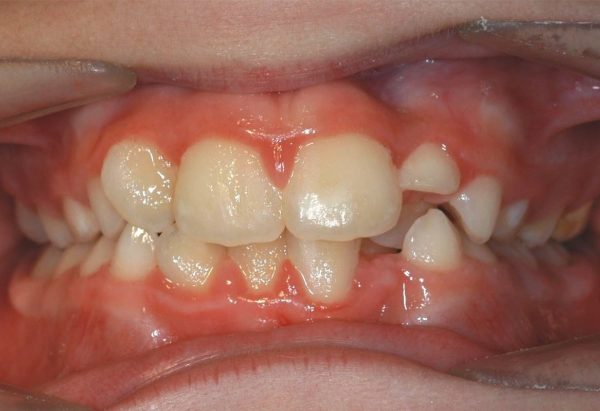 orthodontics in lee's summit