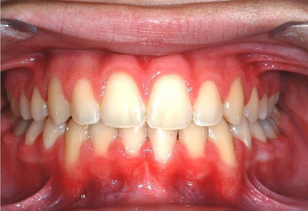 orthodontics in lee's summit