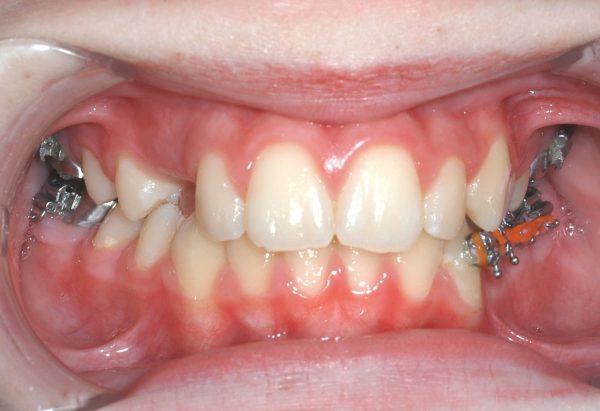 orthodontics in lee's summit