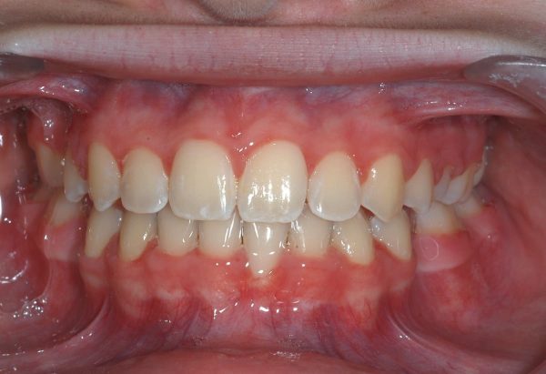 orthodontics in lee's summit