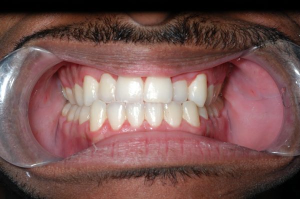 orthodontics in lee's summit