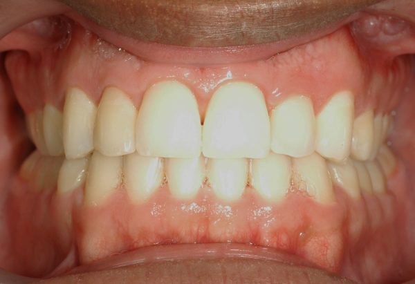 orthodontics in lee's summit