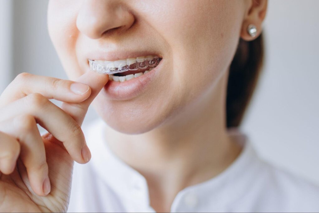 Top 5 Reasons Why Mission Adults Are Choosing Clear Aligners