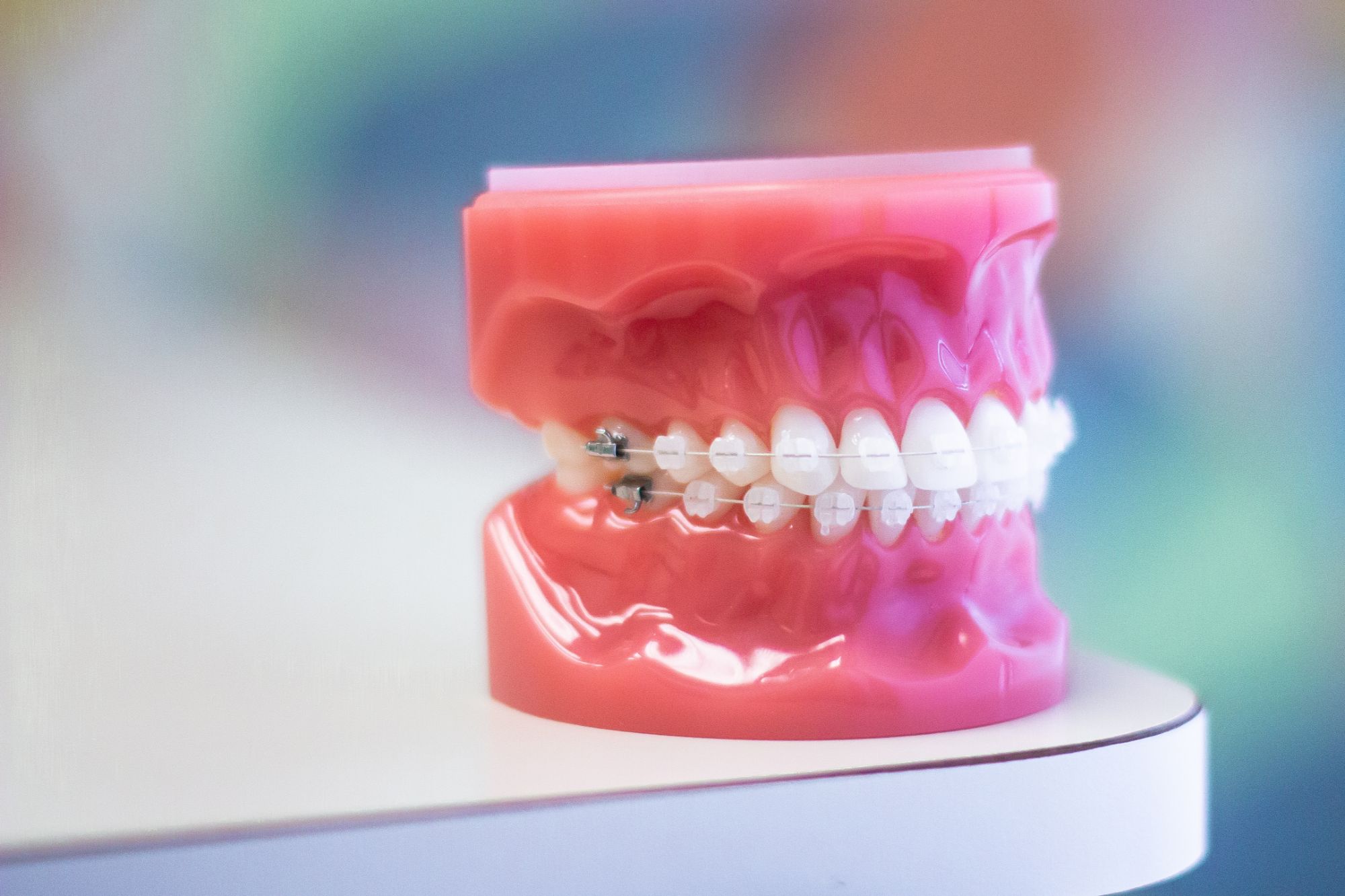 Clear ceramic braces on a dental model of teeth at Lakewood Orthodontics in Lee's Summit, MO