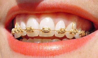 Close-up of gold metal braces on teeth